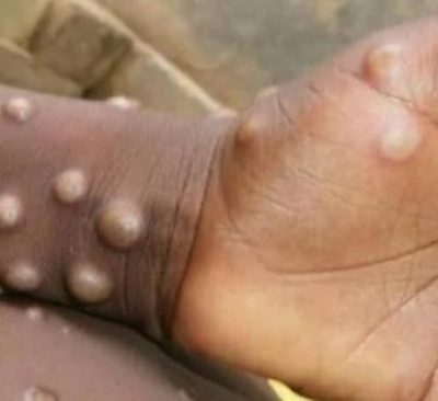Mais de 440 casos confirmados de Mpox em solo nacional