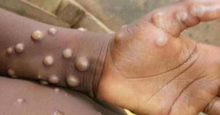 Mais de 440 casos confirmados de Mpox em solo nacional