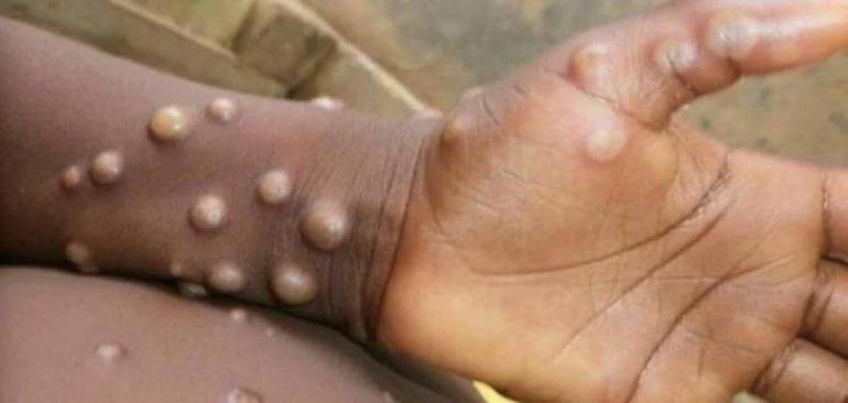 Mais de 440 casos confirmados de Mpox em solo nacional